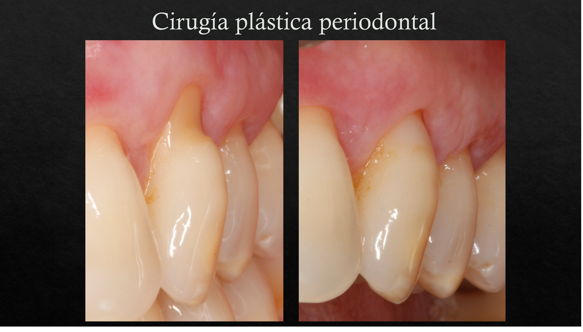 clinicasnortedental -cirugía plastica periodontal