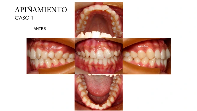 CLINICANORTEDENTAL-CASOS-ORTODONCIA-INVISIBLE-1