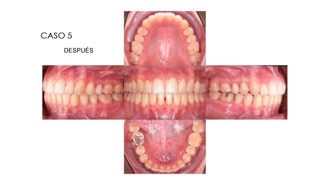 CLINICANORTEDENTAL-CASOS-ORTODONCIA-INVISIBLE-10