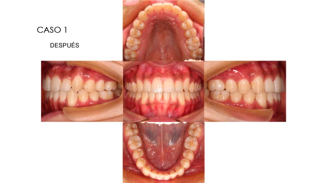 CLINICANORTEDENTAL-CASOS-ORTODONCIA-INVISIBLE-2