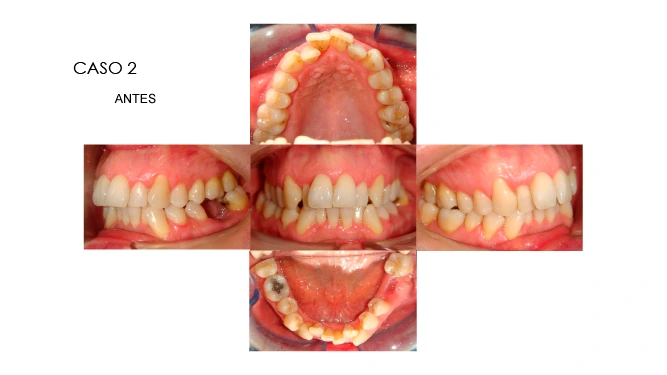 CLINICANORTEDENTAL-CASOS-ORTODONCIA-INVISIBLE-3