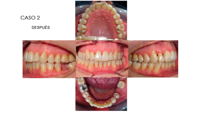 CLINICANORTEDENTAL-CASOS-ORTODONCIA-INVISIBLE-4