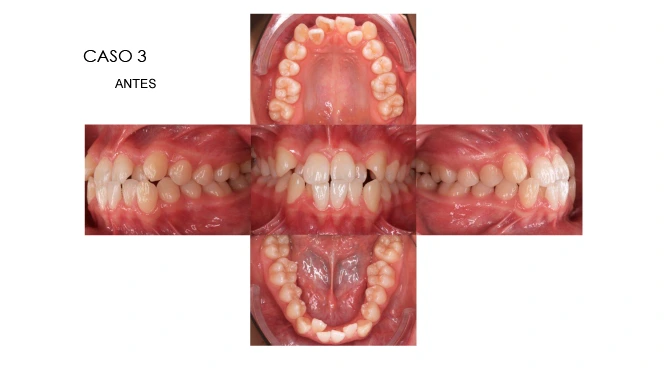 CLINICANORTEDENTAL-CASOS-ORTODONCIA-INVISIBLE-5