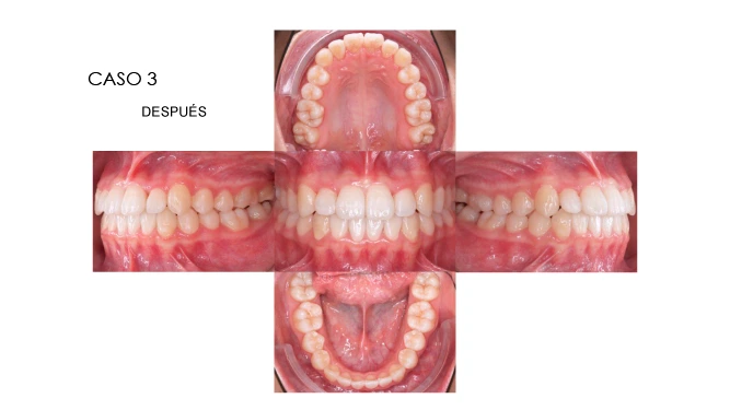 CLINICANORTEDENTAL-CASOS-ORTODONCIA-INVISIBLE-6