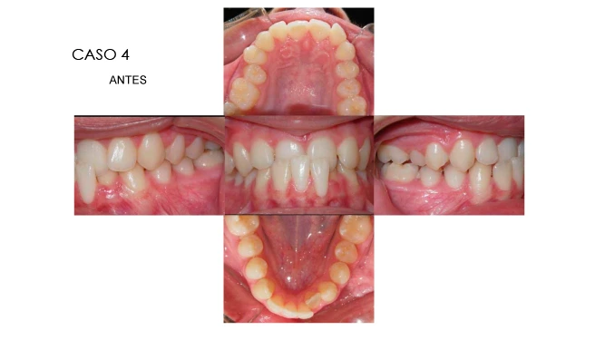 CLINICANORTEDENTAL-CASOS-ORTODONCIA-INVISIBLE-7
