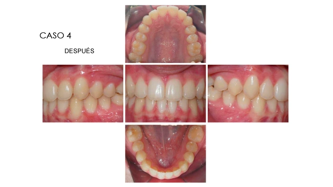 CLINICANORTEDENTAL-CASOS-ORTODONCIA-INVISIBLE-8
