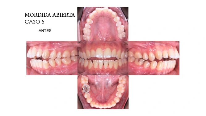 CLINICANORTEDENTAL-CASOS-ORTODONCIA-INVISIBLE-9