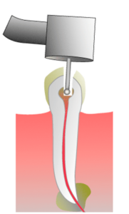 ENDODONCIA-FASE-1-clinicasnortedental-181x300