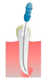 ENDODONCIA-FASE-2-clinicasnortedental-181x300