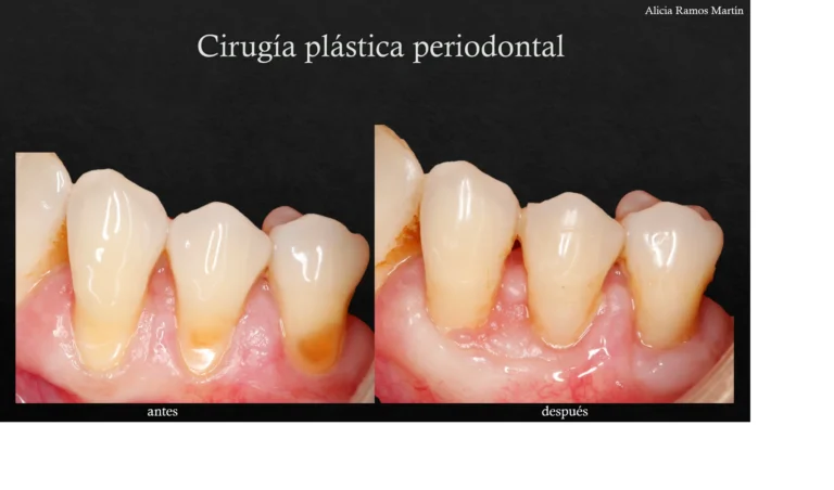clinicasnortedental-cirugia-plastica-periodontal-3-2133x1254
