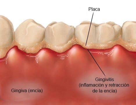 tratamiento-gingivitis-2